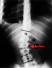 Scoliosis Scoliosis (4).gif